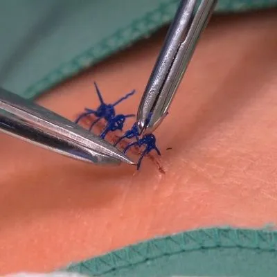 Sutures Removal at Home in Dubai & Abu Dhabi