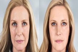 facial treatment before & after dubai