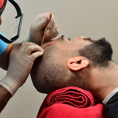 Can Hair Be Transplanted From the Body to the Scalp In Dubai