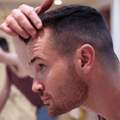 Do Hair Transplant Work On The Crown?