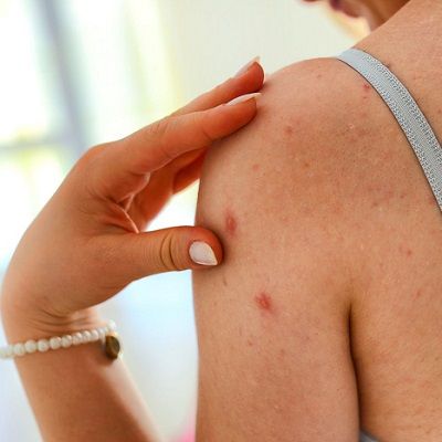 Do Pimples On Your Arms Bother You? Here Are Treatments To Get Rid Of Them