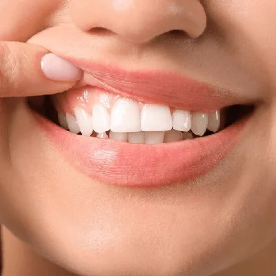 Gum Depigmentation Cost in Dubai & Abu Dhabi