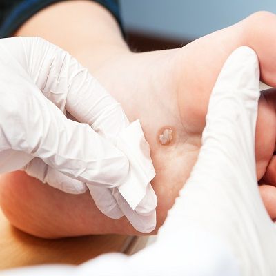 Laser Surgery for Warts In Dubai