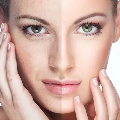 Chemical Peels in Dubai | Facial Peel