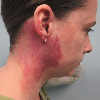 Best Laser Treatment For Port Wine Stains in Dubai