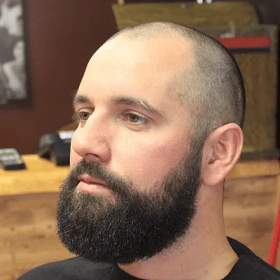 Can Hair Grow Back After Balding In Dubai
