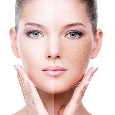 How To Remove Pigmentation From Face Permanently In Dubai