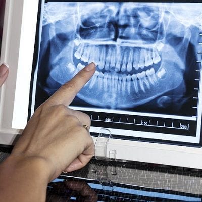 Learn the Types and Misconceptions About Dental X Rays