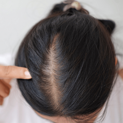 What Is Female Pattern Baldness In Dubai