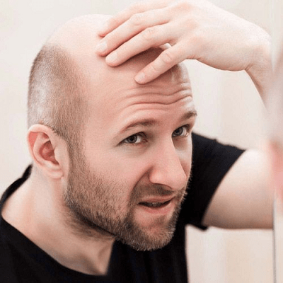What Is The Best Solution For Male Baldness In Dubai