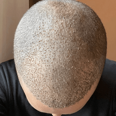 Hair Transplants And Scabs: Why Do They Appear