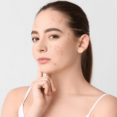 Say Goodbye to Hormonal Acne With Quick And Effective Treatment