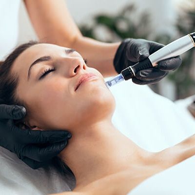 Intracel Microneedling and Radiofrequency – Treatments
