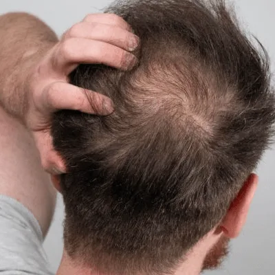 Hair Plugs VS Hair Transplant
