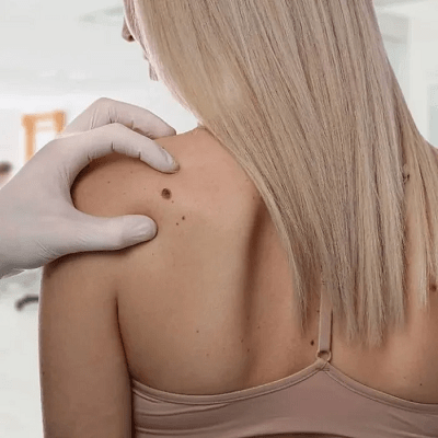 How Do You Get Rid Of Skin Tags In One Night In Dubai?