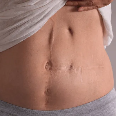 Hysterectomy in Dubai & Abu Dhabi