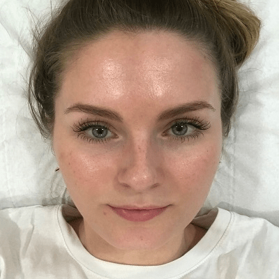 Smooth and Soothe: Facial Capillaries Treatment in Dubai