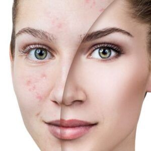 Best Facials for Scars & Hyperpigmentation