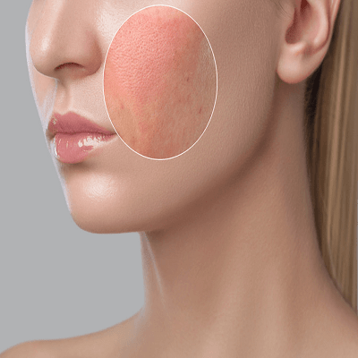 What can a Dermatologist Do for Rosacea?