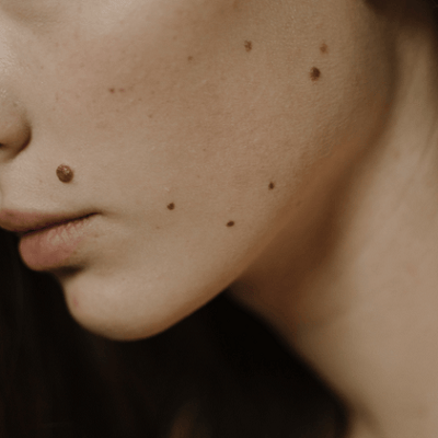 Why am I Getting Moles on My Face?