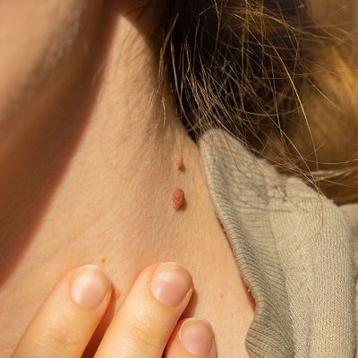 Can Cryotherapy Remove Skin Tag?