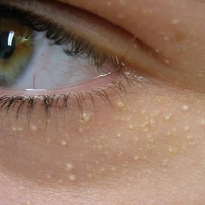 cost of milia treatment in dubai