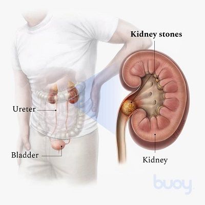 Surgical Kidney Stone Removal in Dubai & Abu Dhabi