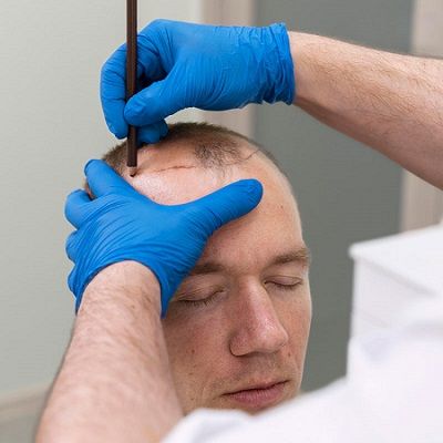 Advanced Technology And Facilities For FUE Hair Transplant In Dubai