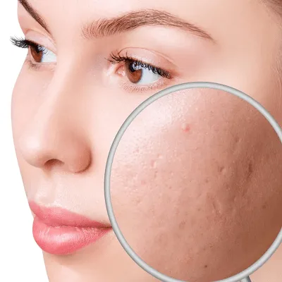 Boost Your Glow with Laser Acne Treatment