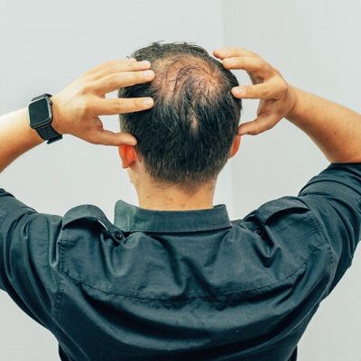 Cost Of Hair Transplant May Vary From Person To Person