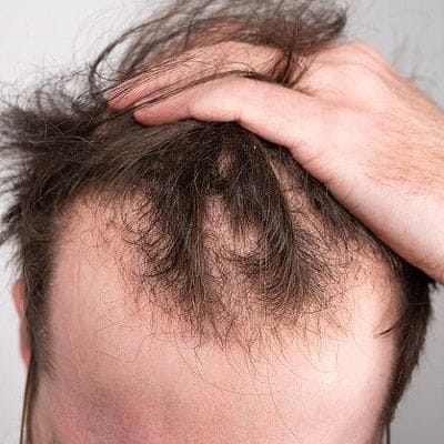 Healthy Hair from Root to Tip with Hair Restoration in Dubai