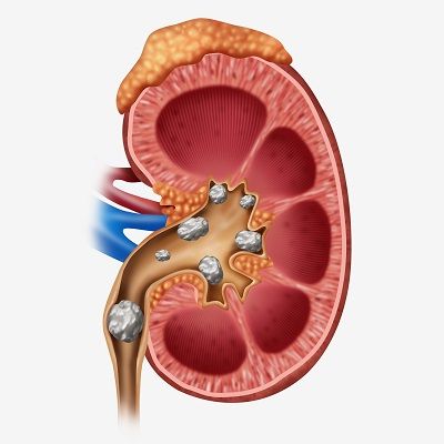 Why is Kidney Stone Removal Necessary?