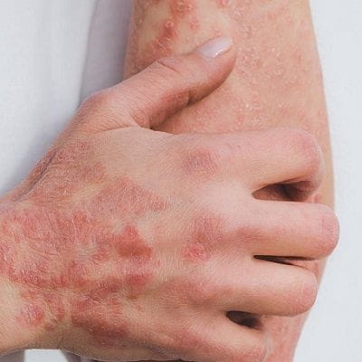Winter Skin Problems: Navigating Skin Diseases