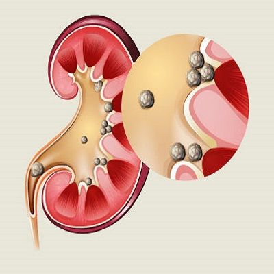 4 Methods For Kidney Stone Removal In Dubai