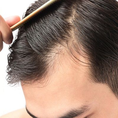 Transform Your Image With Hair Transplant In Dubai