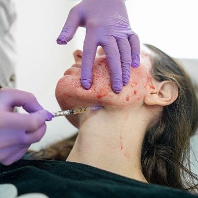 Vampire Facial Cost