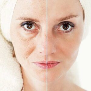 Get Younger by Skin Tightening and Contouring Treatment