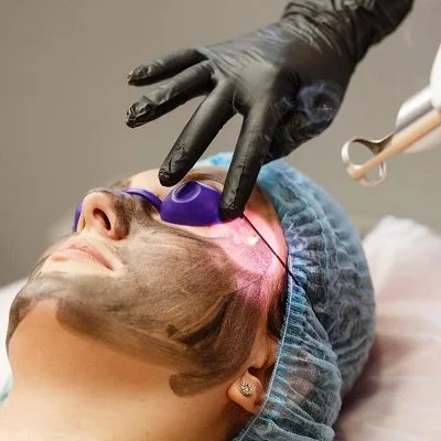 Laser Carbon Peels Cost in Dubai