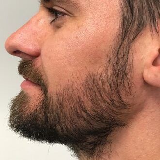 Shape Your Identity with Beard Hair Transplant in Dubai