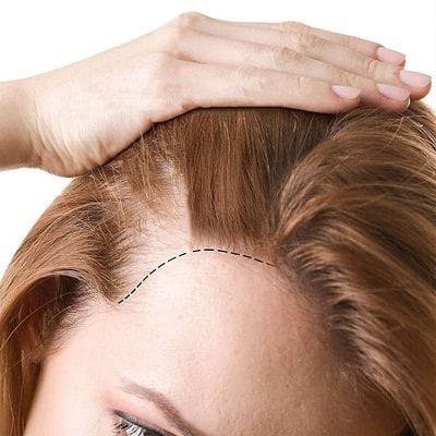 Unveiling the Best Hair Implant Clinics in Dubai