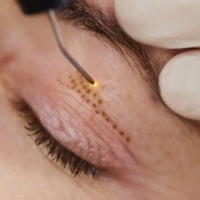 Look Younger with Plexr Plasma Eyelift in Dubai