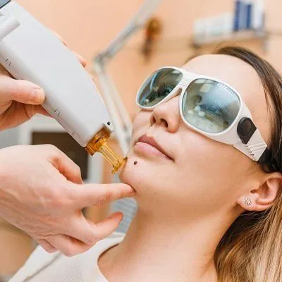 Mole Removal in Dubai