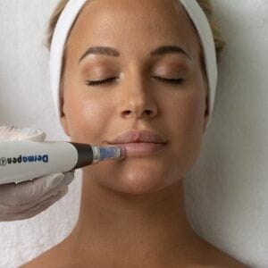Dermapen Treatment for Minimising Pores