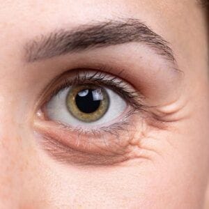 Reduce Puffiness with Eye Bag Removal