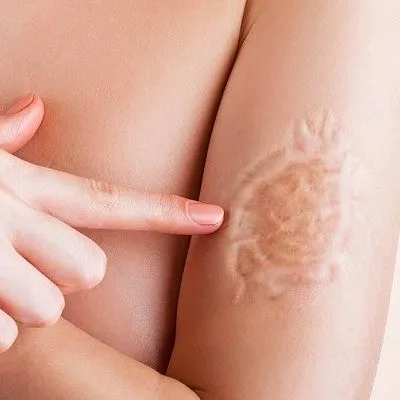 Scar Laser Treatment in Dubai