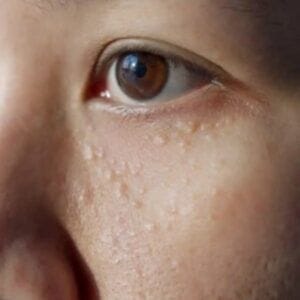 Can Laser Treatment Remove Eye Syringoma?