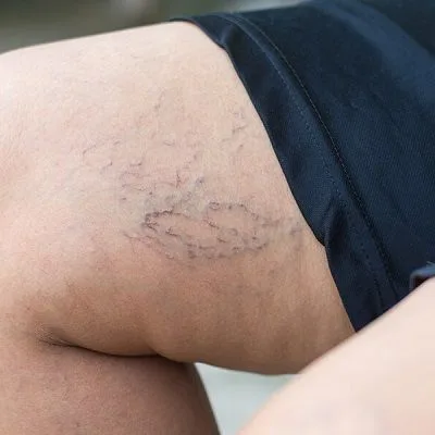Spider Veins Treatment in Dubai