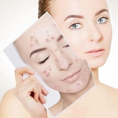 Acne Scar Treatment in Al Warqa
