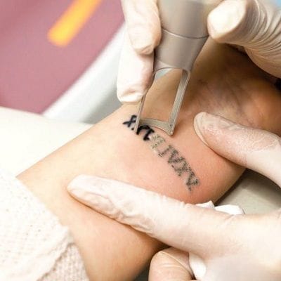 Can A Tattoo Be Fully Removed?