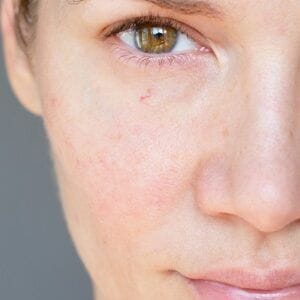 How To Get Rid of Rosacea Permanently?